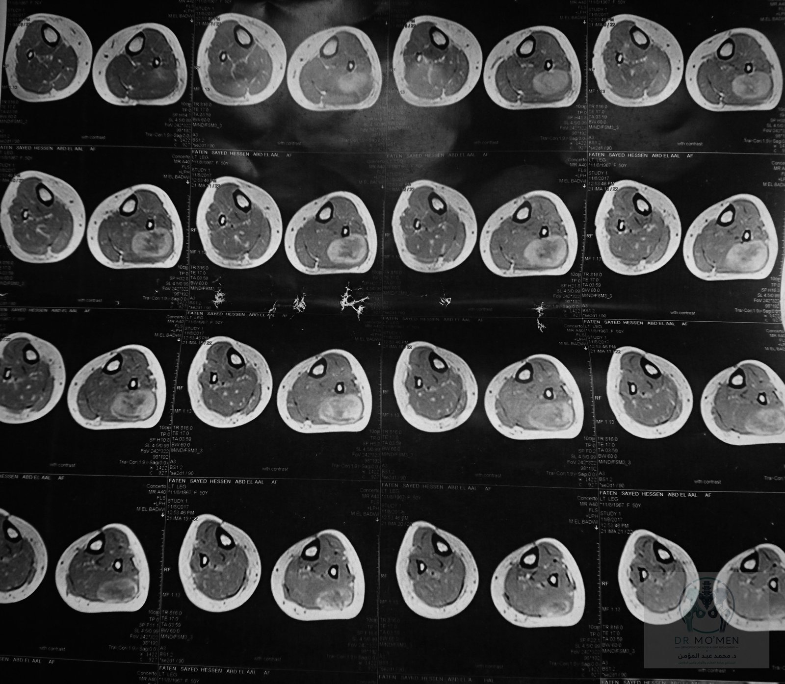 Axial MRI view showing proximity to the neurovascular plane.