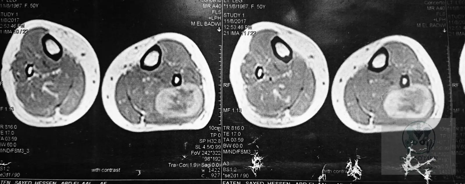 Final axial MRI view in the original uncropped format.