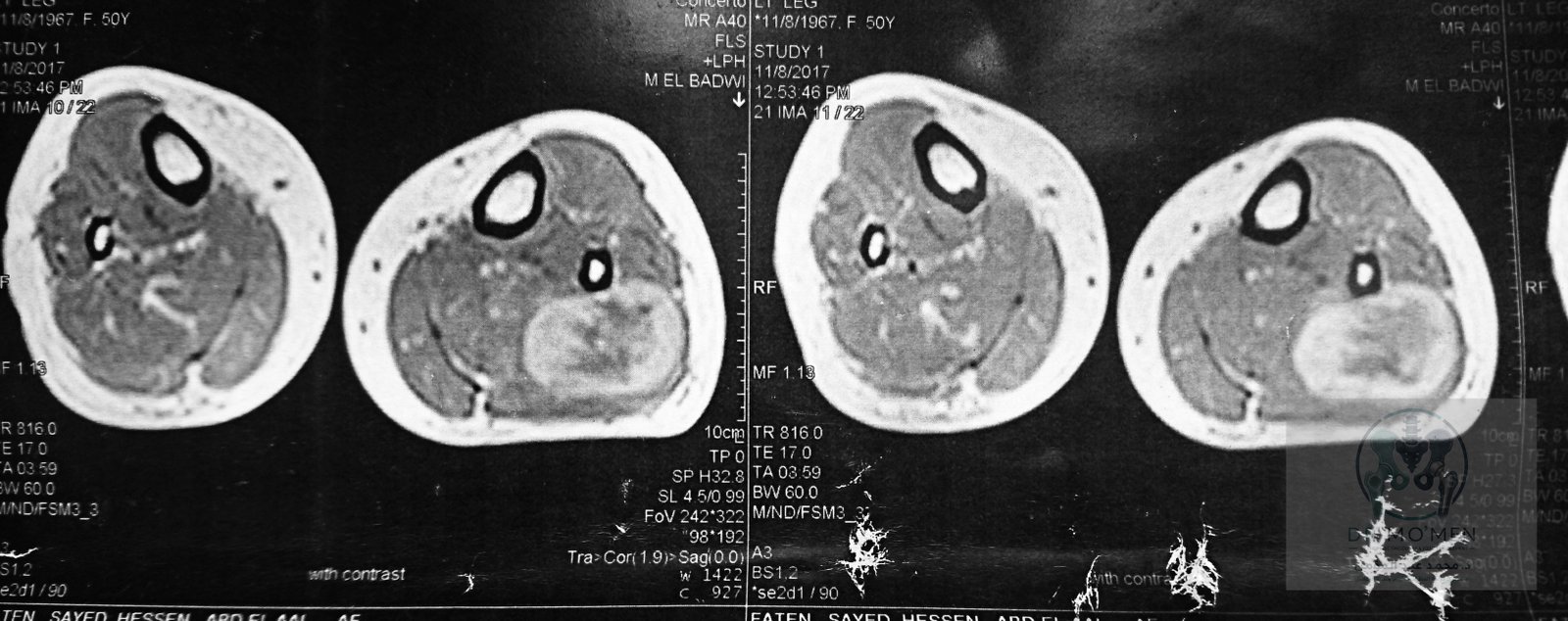 Final axial MRI view in the original uncropped format.