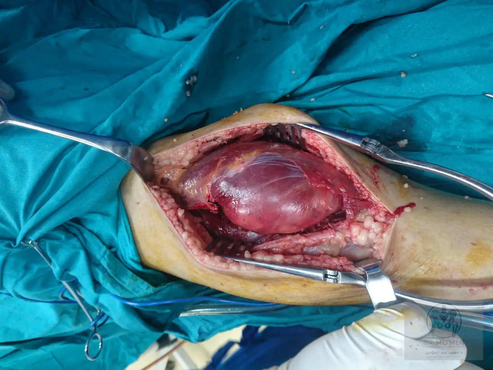 Intraoperative exposure of the deep posterior calf mass.