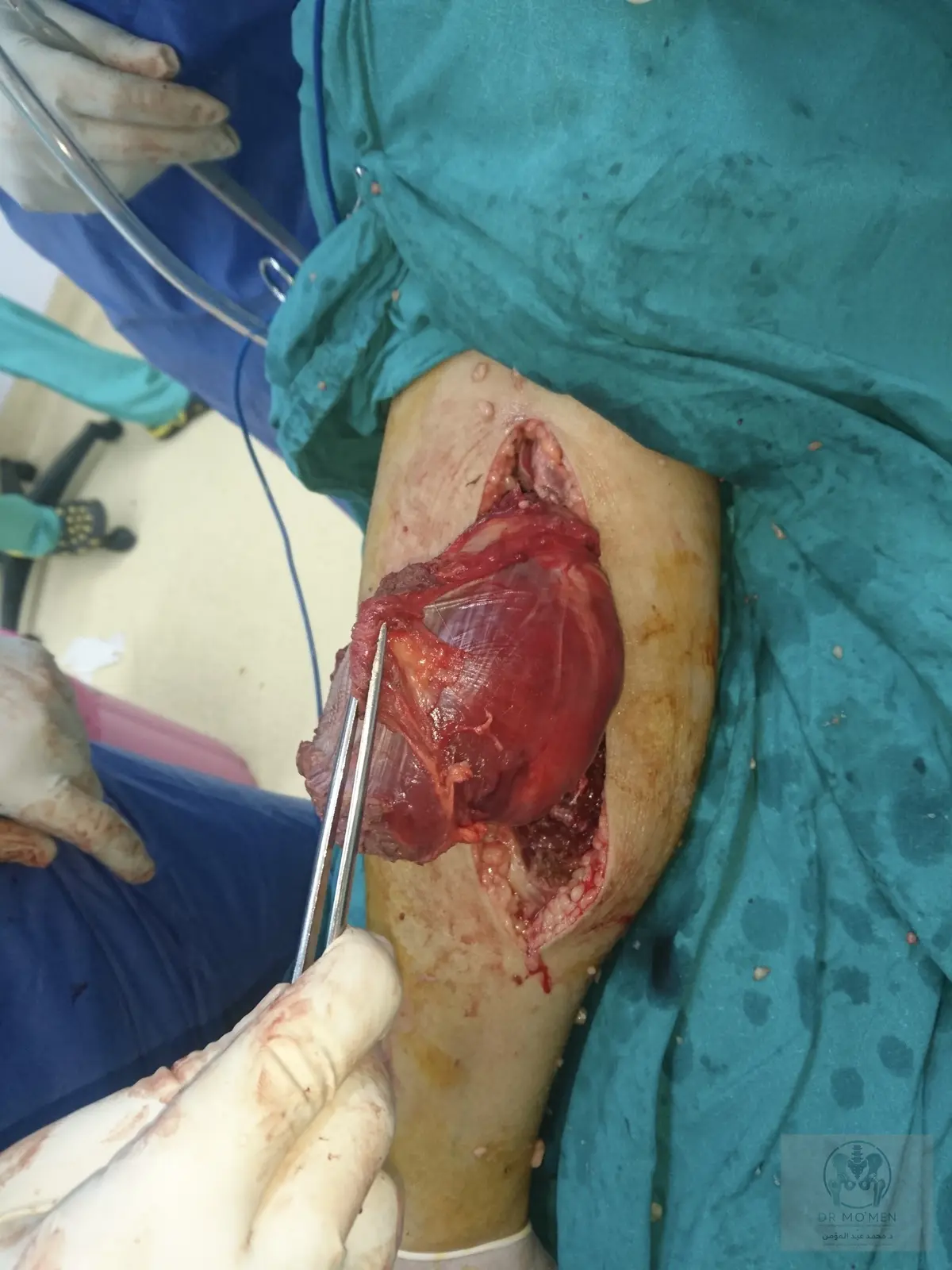 Operative view of the smooth, well-circumscribed mass that raised the possibility of a benign peripheral nerve sheath tumor.