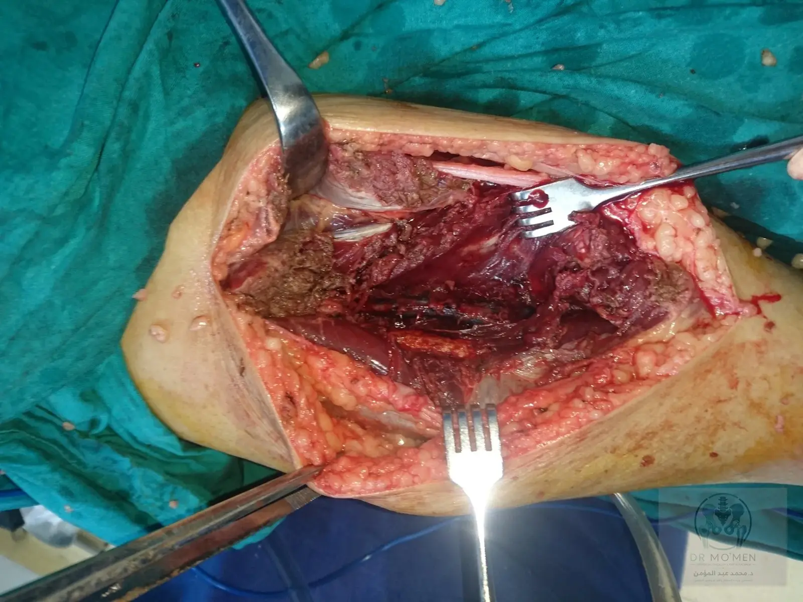 Tumor bed after excision, demonstrating the operative field.