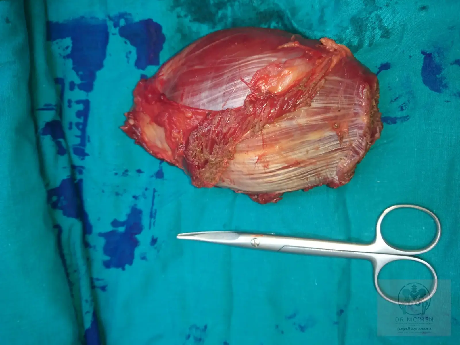 Gross specimen after en bloc excision.