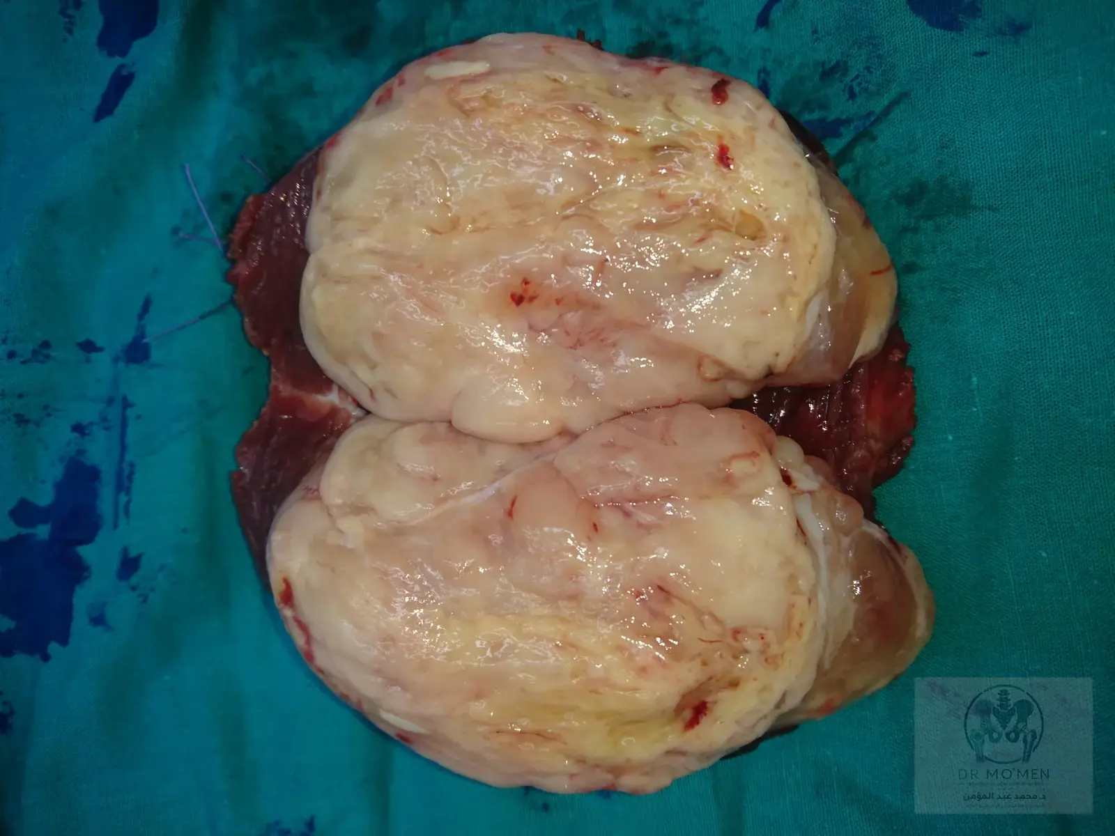Cut surface of the excised tumor demonstrating a myxoid appearance.