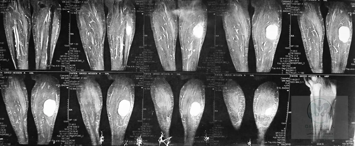 High-Grade Myxoid Liposarcoma of the Calf Mimicking a Benign Mass