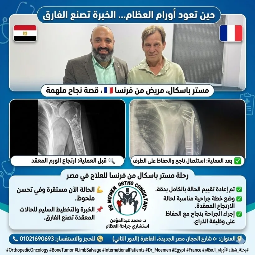 حالة قبل وبعد لعلاج ورم عظمي مرتجع بعظمة العضد مع الحفاظ على الطرف